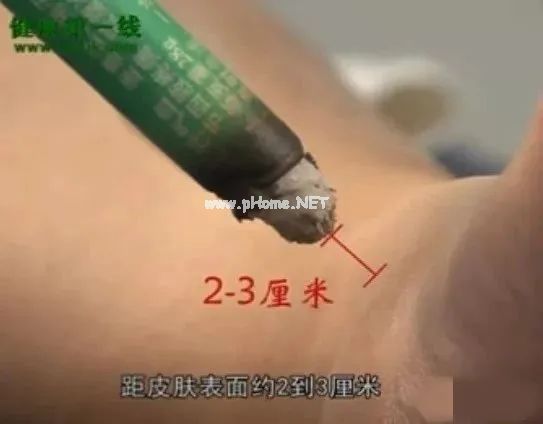 官文发布：防治新冠肺炎的艾灸方案