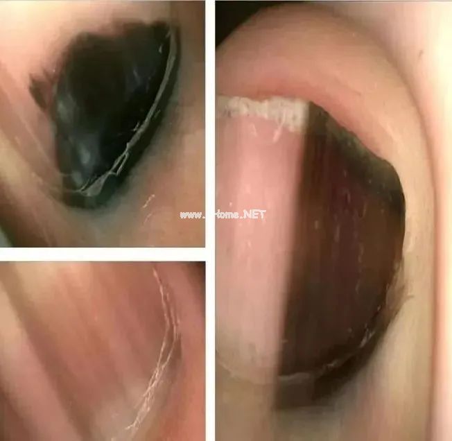 孩子指甲这4种表现是患病信号！第1种可能预示肿瘤
