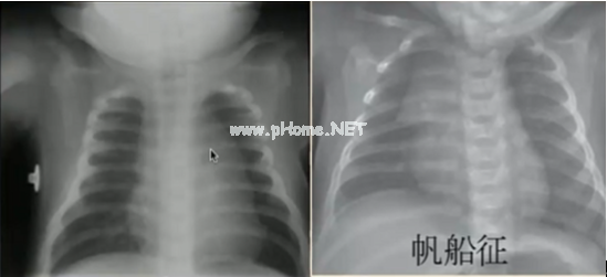 读完此文，终于会看儿童胸片了！