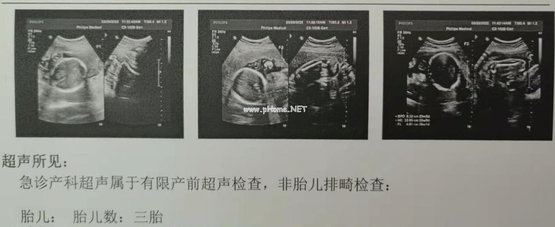 国内首例！四胞胎孕妇分3次分娩，怀孕胎数不是越多越好