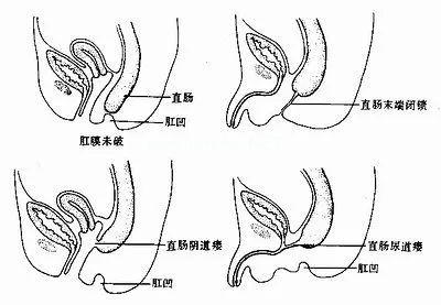 为什么孩子生下来没有肛门? 为什么孩子生下来没有肛门?