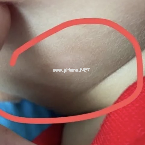 孩子皮肤白了一块？多半是这4种皮肤病