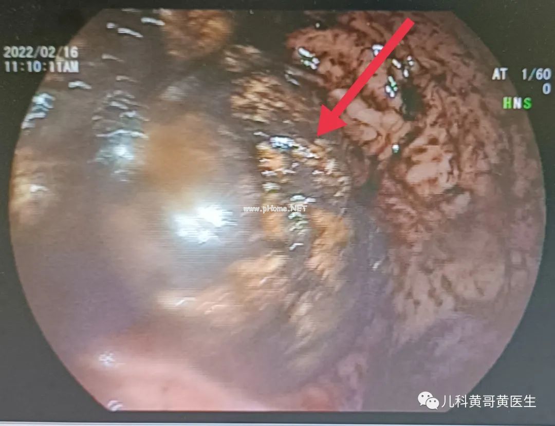三岁女童呕血，竟然是因为吃多了这个东西