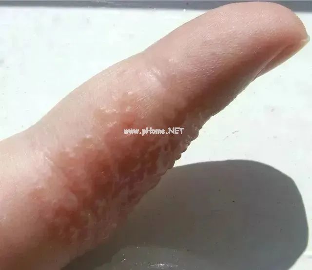 为何一到换季，​宝宝就手脱皮？