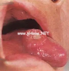 【收藏】61张高清舌诊图谱，图文对照