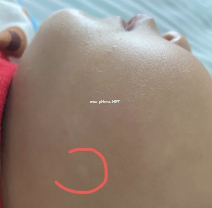 孩子皮肤白了一块？多半是这4种皮肤病