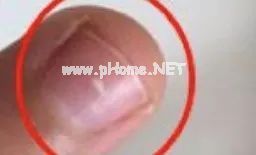 孩子指甲这4种表现是患病信号！第1种可能预示肿瘤