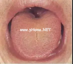 【收藏】61张高清舌诊图谱，图文对照