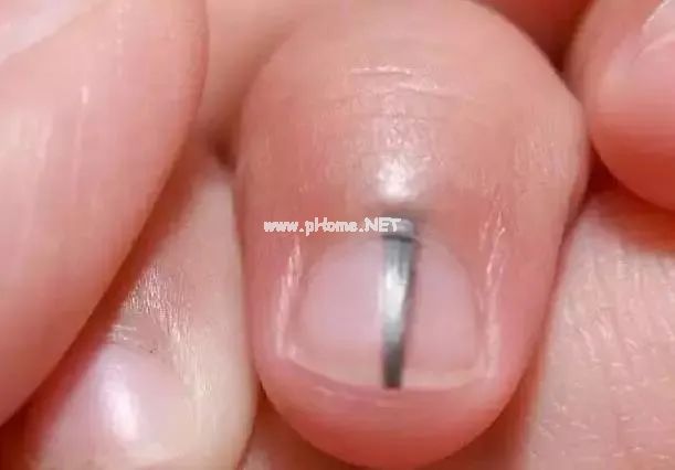 孩子指甲这4种表现是患病信号!第1种可能预示肿瘤 孩子指甲这4种表现是患病信号!第1种可能预示肿瘤