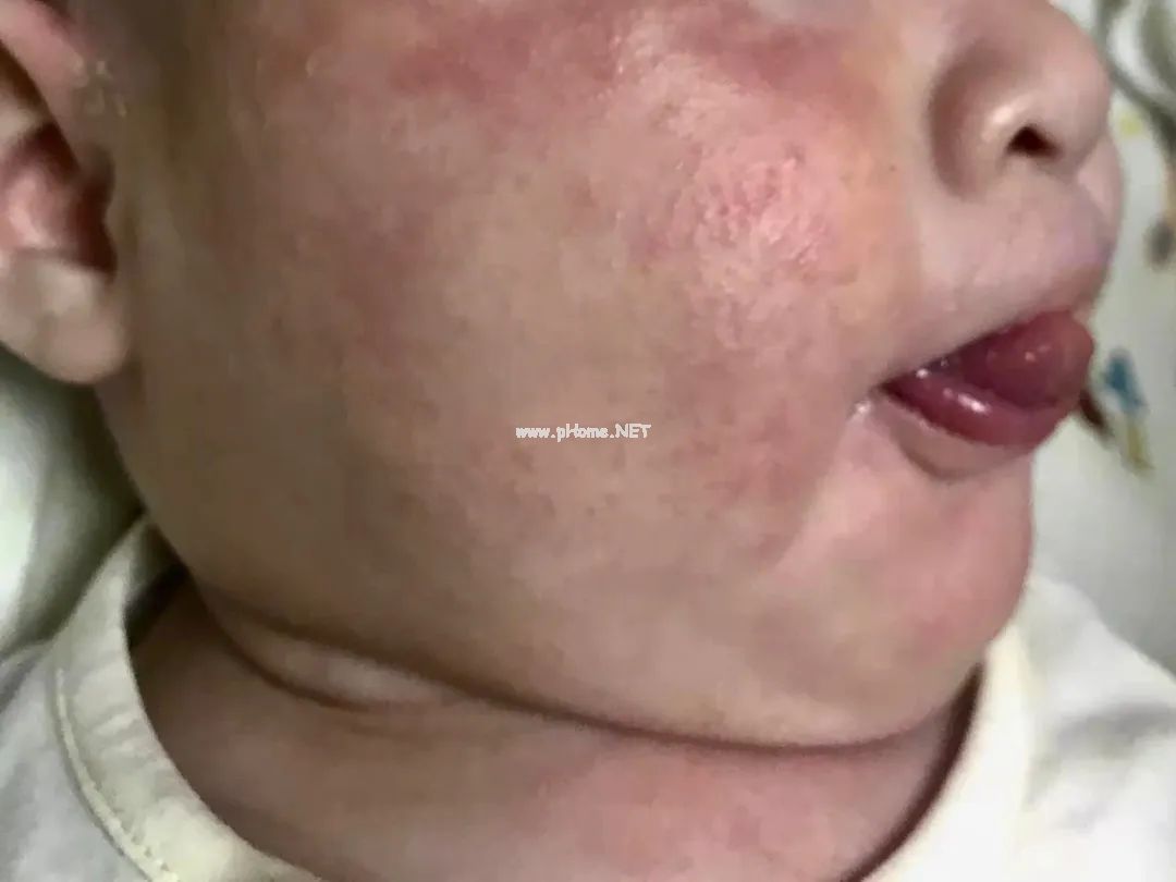 明明70%的湿疹都是轻症，为什么你家孩子就是治不好？