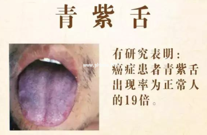 两种舌象：可能是癌症高危人群？