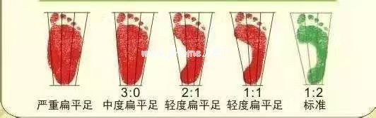 快看看孩子鞋底，有这种形状，小心足外翻！