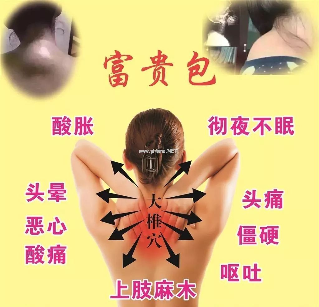 小心 “富贵包” 要了命！