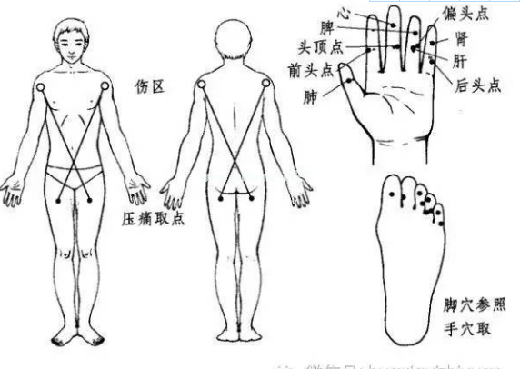中风偏瘫，“治瘫点”是最方便的疗法