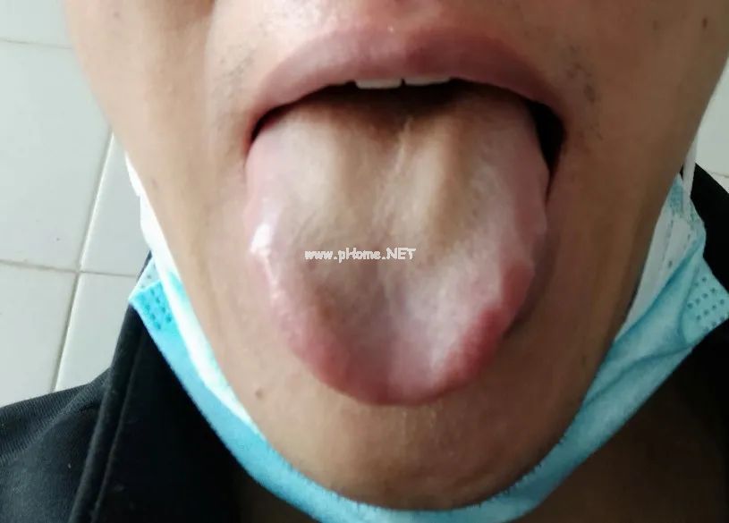 转：我用中医治疗自己新冠全过程（记录）