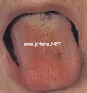 【收藏】61张高清舌诊图谱，图文对照