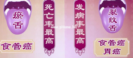 两种舌象：可能是癌症高危人群？