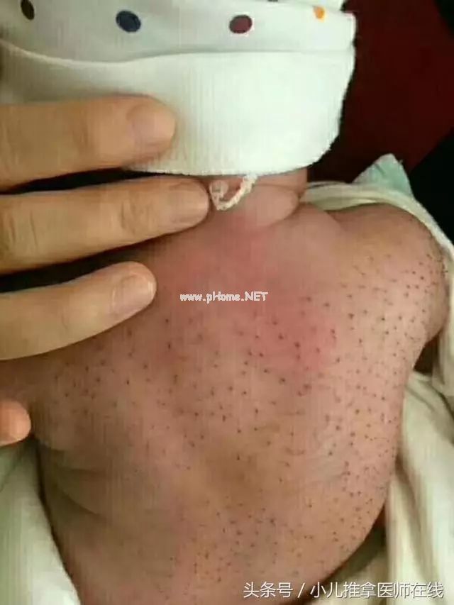 如何科学看待猪毛风，程老师详细介绍“小儿猪毛风”的前世今生