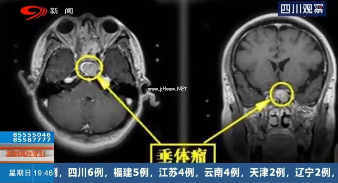 12岁195cm，专家提醒：长太快不一定是好事