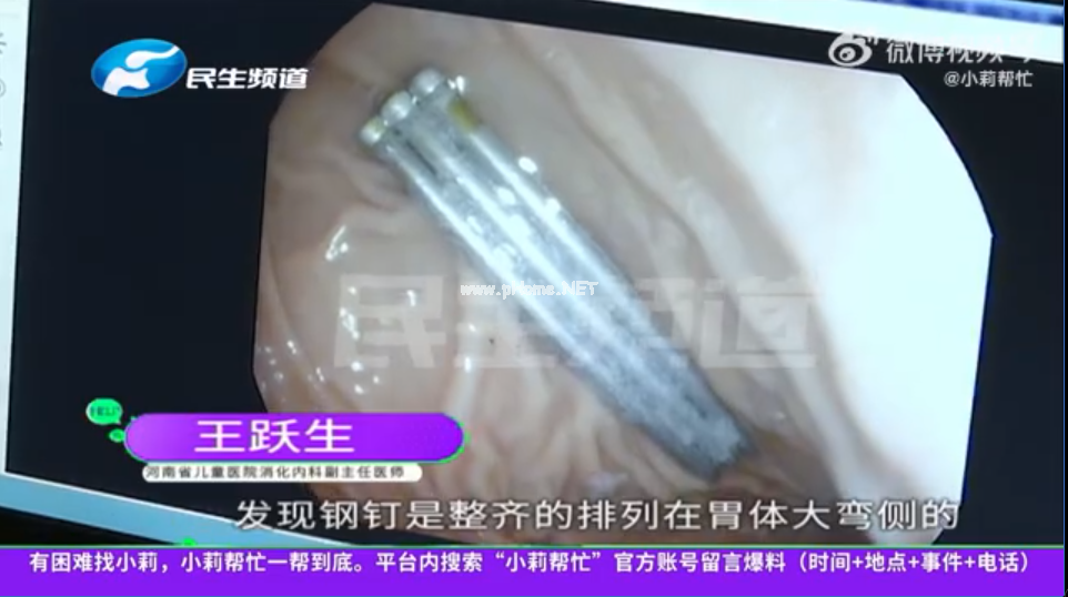 1岁宝宝胃里竟有3根钢钉，儿童消化道异物怎么处理？