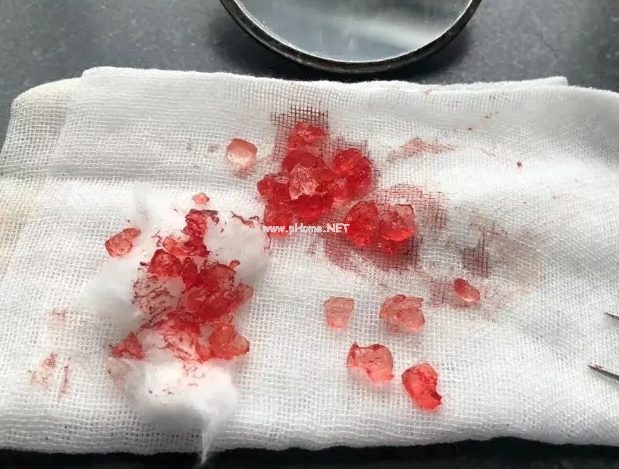 2岁儿童摔倒，筷子直接从鼻腔插入眼眶……