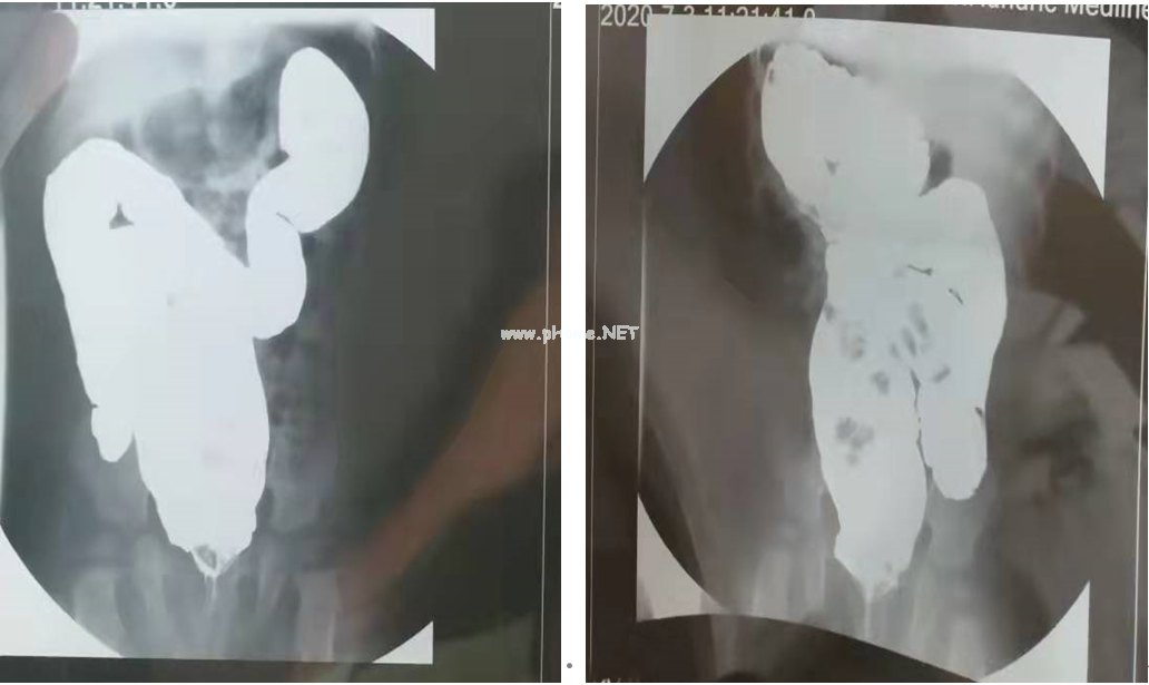 孩子便秘拉不出,竟然是肠子“太长”? 孩子便秘拉不出,竟然是肠子“太长”?