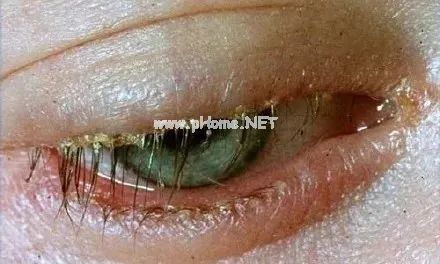 ​痒痒痒，女童睫毛里竟藏21条螨虫