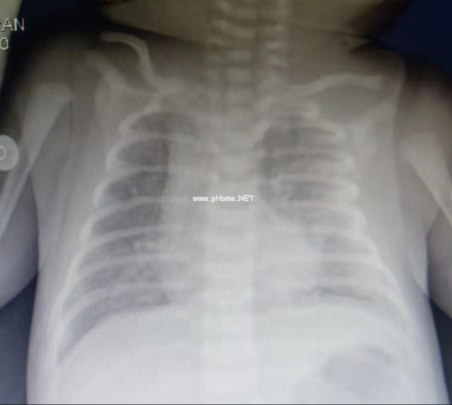 新生儿细菌性肺炎，为啥抗感染治疗后不能痊愈？