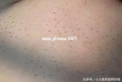 如何科学看待猪毛风，程老师详细介绍“小儿猪毛风”的前世今生