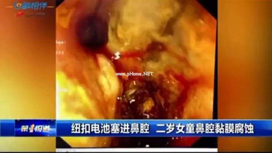 2岁儿童摔倒，筷子直接从鼻腔插入眼眶……