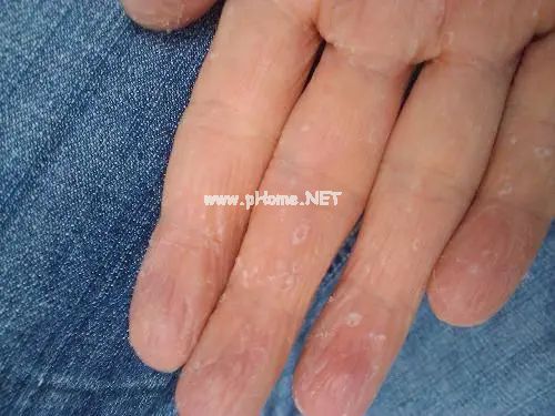 为何一到换季，​宝宝就手脱皮？