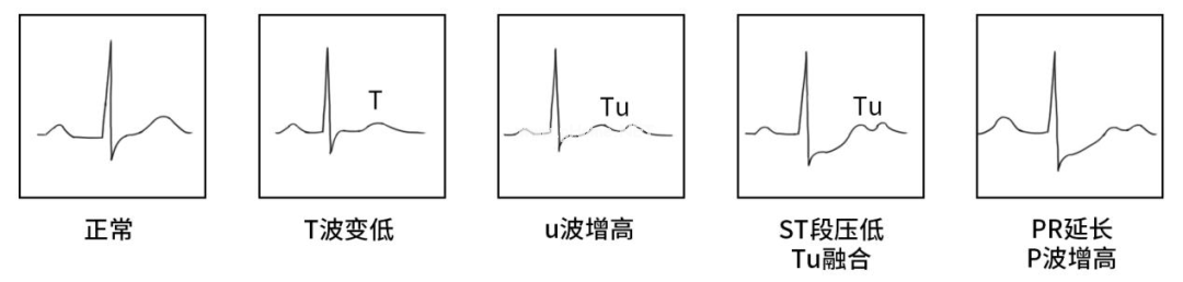 儿童血钾紊乱不知如何处理？从分类到治疗一文搞定！（下）