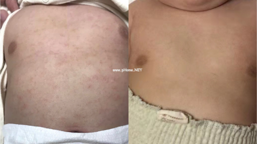 明明70%的湿疹都是轻症，为什么你家孩子就是治不好？