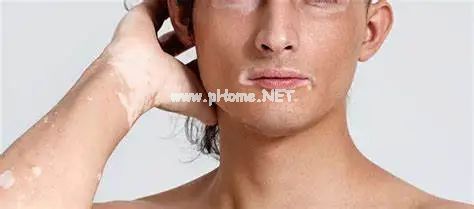 孩子皮肤白了一块？多半是这4种皮肤病