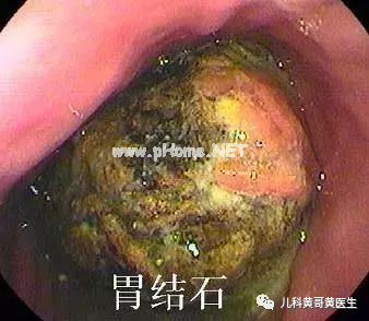三岁女童呕血，竟然是因为吃多了这个东西